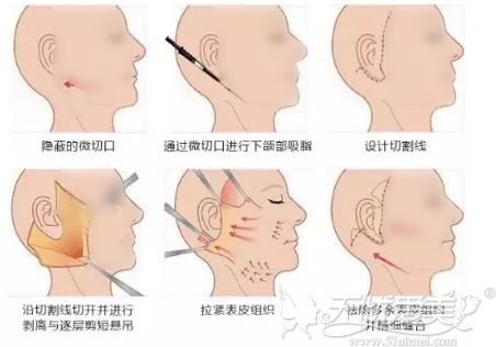 面部拉皮手术