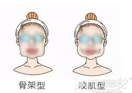 骨架型下颌角肥大和咬肌型下颌角