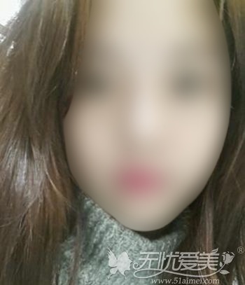 在韩国原辰做双眼皮手术+面部轮廓手术后半年