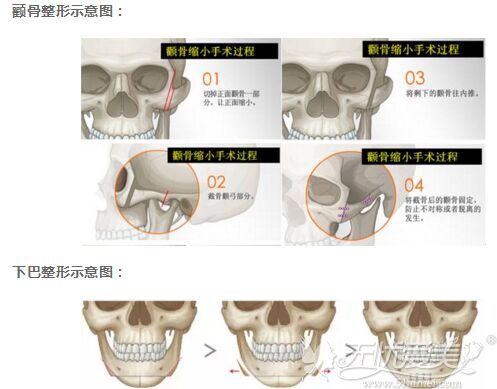 颧骨和下巴整形需要用钛钉固定