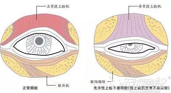 正常眼睑和上睑下垂眼睑