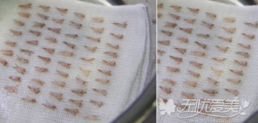 做发际线种植前提取毛囊