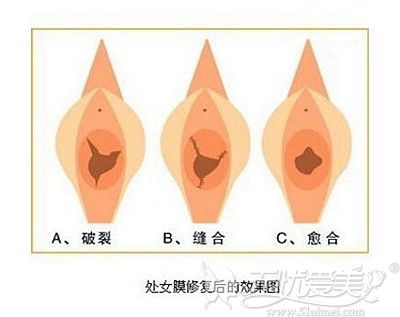 处女膜修复过程和效果