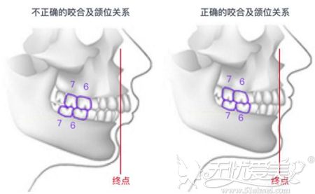 牙齿畸形导致下巴后缩