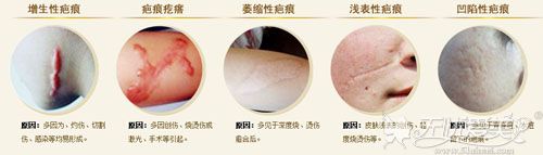 祛疤痕手术是真的吗?亲测对凹陷、萎缩及增生性瘢痕有效