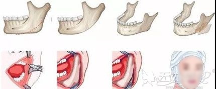 下颌角整形手术过程