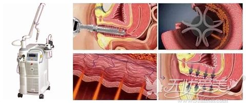 欧洲之星私密激光治疗阴道松弛