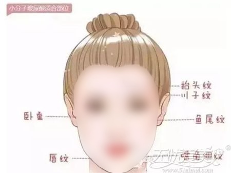 小分子玻尿酸适用部位