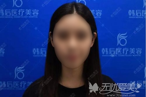 在佛山做了硅胶垫鼻梁后没效果就找广州韩后崔东失败修复