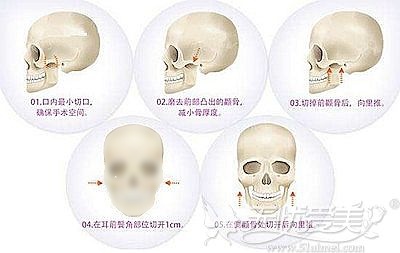 上海哪些医院有资质做颧骨内推?华美/美联臣皆可
