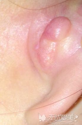 耳软骨隆鼻后耳朵疤痕增生