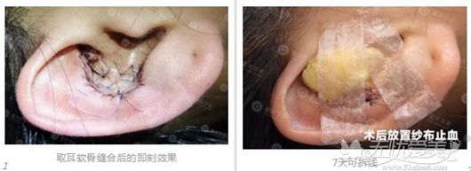 耳软骨隆鼻是取耳软骨的伤口