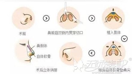 鼻小柱延长手术过程
