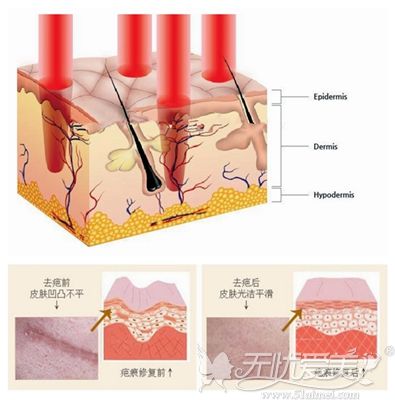 激光祛疤的原理