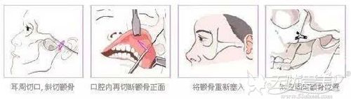 颧弓内推手术的原理