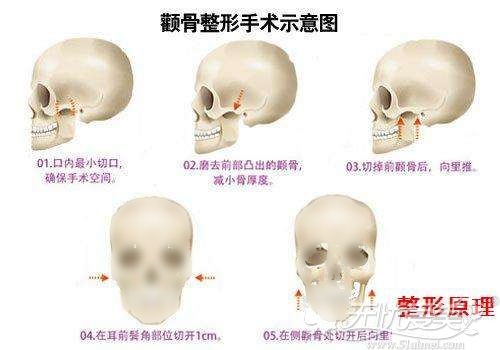 颧骨降低手术的原理