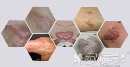 各种疤痕在皮肤形成的疤痕增生