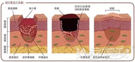 疤痕增生在皮肤层形成的原理