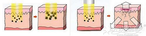 激光祛斑的原理解析