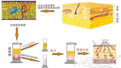 经过过滤后的自体脂肪移植