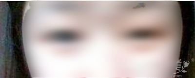 肿眼泡可以做韩式微创双眼皮吗？它和全切有什么区别？