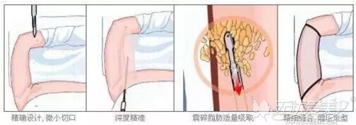 腰腹吸脂的原理