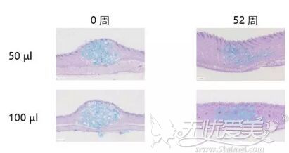 瑞蓝丽瑅玻尿酸效果维持时间更长