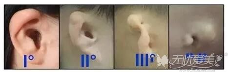 小耳畸形不同程度的畸形
