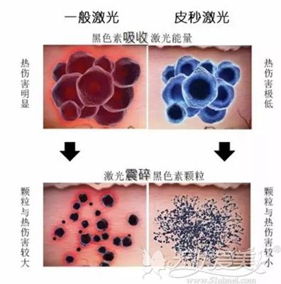 美国赛诺秀755蜂巢皮秒祛斑原理