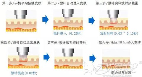 黄金微针去除狐臭过程