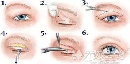 眼皮松弛做全切双眼皮手术过程