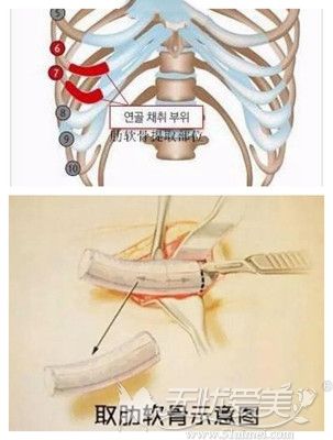 取肋骨隆鼻切口