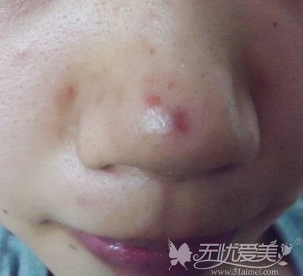 激光对鼻子上的凸起性痘疤有作用吗？多少钱一次？