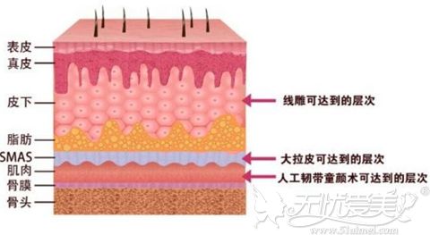 人工韧带童颜术原理