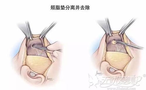 去颊脂垫的切口位置