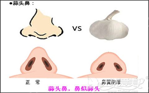 蒜头鼻型常常让人感觉鼻子形态扁扁的