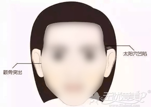 面部凹陷容易显得人比较老态