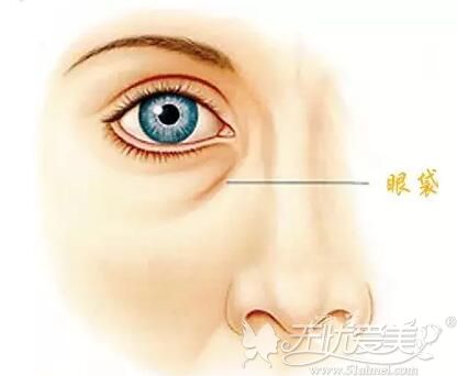 科普：眼部眶隔脂肪释放术的优势及和传统去眼袋的区别