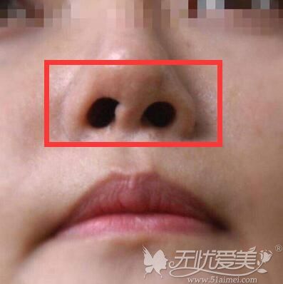 隆鼻后出现鼻孔左右不对称的现象