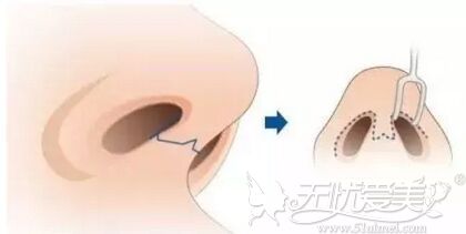 隆鼻手术切口