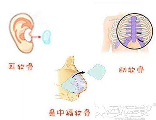 自体软骨隆鼻材料