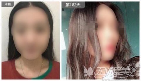 昆明吴氏嘉美整形医院隆鼻真人案例