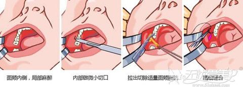 去颊脂垫手术过程