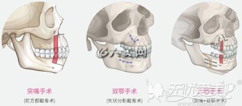 双颚手术的分类