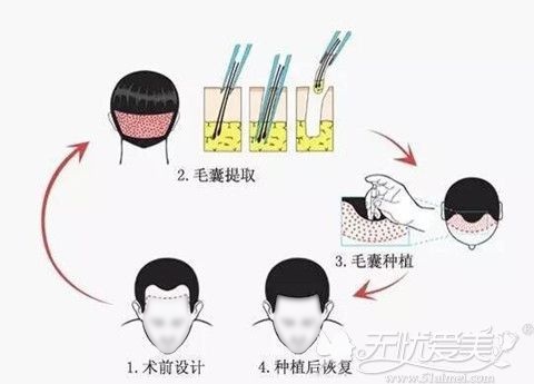 发际线移植手术过程