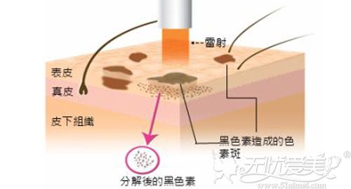 激光祛雀斑治疗原理