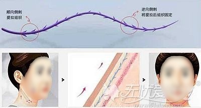 面部提升采用意大利悦升线怎么样?术后能维持多久什么价位