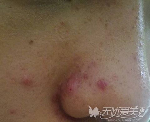 鼻子上长痘可以做隆鼻手术吗?隆鼻后鼻子长痘会影响膨体吗?