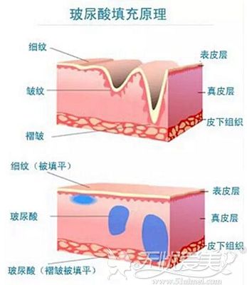 玻尿酸的填充原理