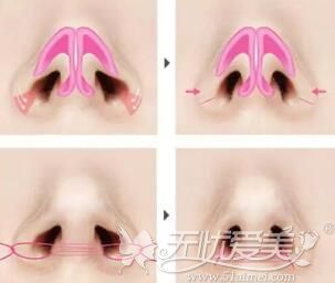 鼻翼内切法